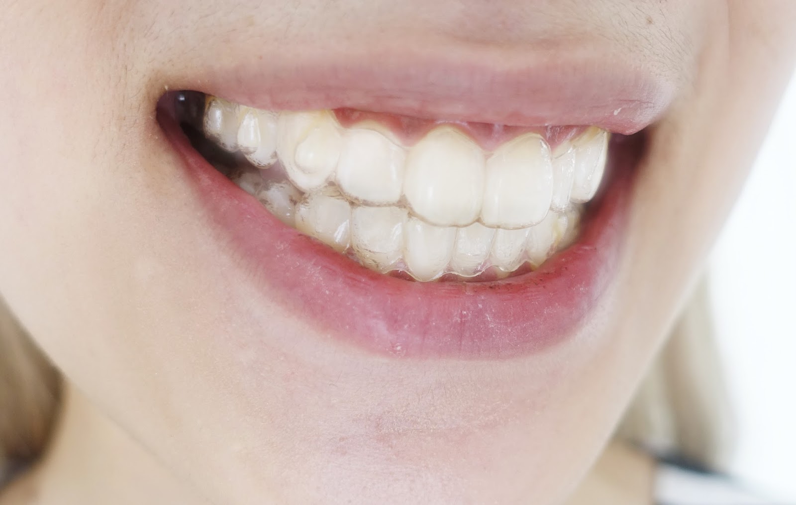 baseren plein Ontoegankelijk Onzichtbare beugels – Orthodontist Hereplein