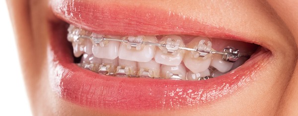 Efficiënt koper Leonardoda Onzichtbare beugels – Orthodontist Hereplein