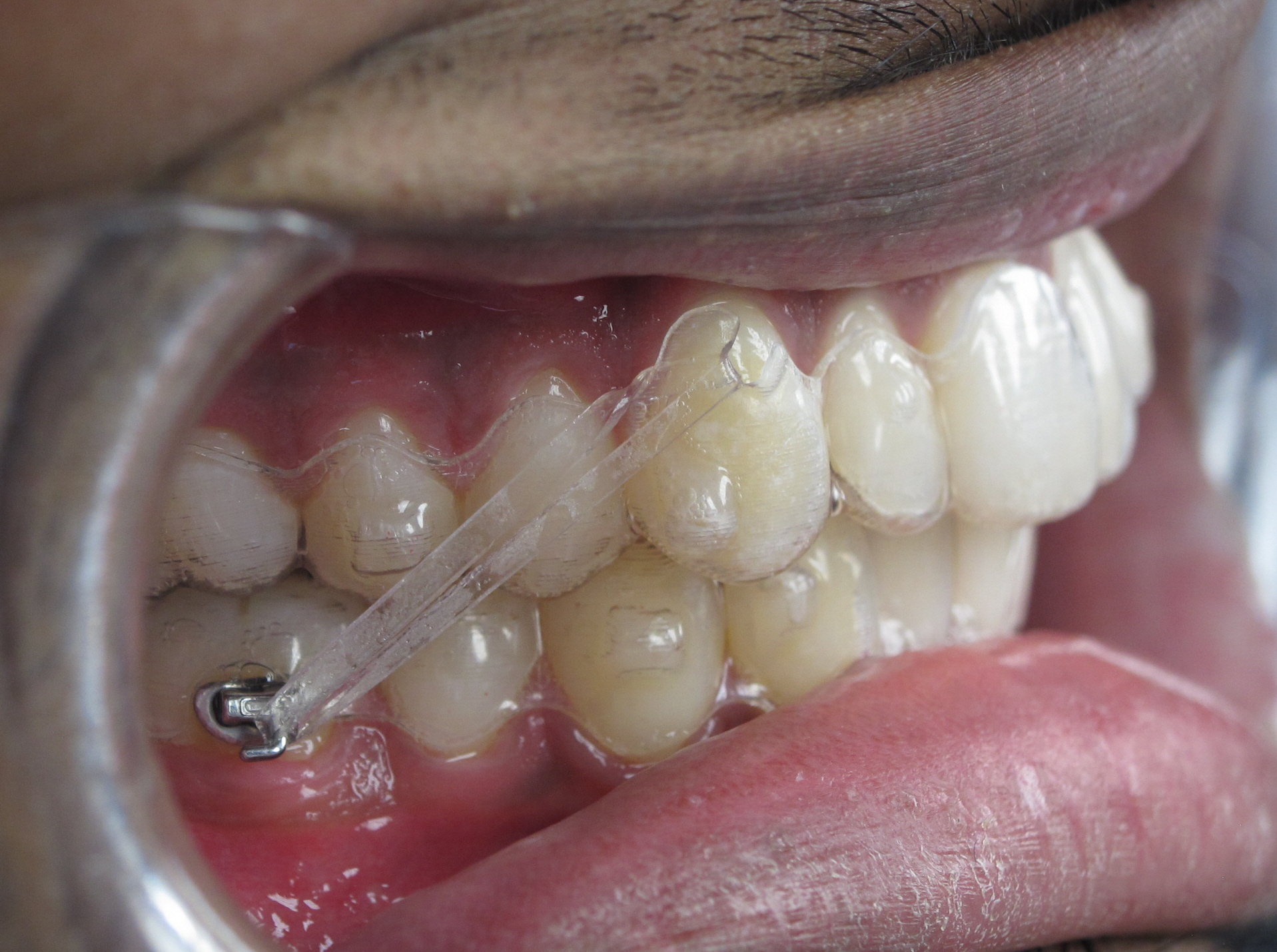 volgens Verklaring exotisch Onzichtbare Beugels – Orthodontist Hereplein